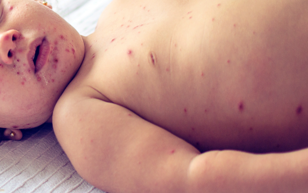 How Stupidity and Misinformation is Causing the Deadly Resurgence of Measles Around the Globe