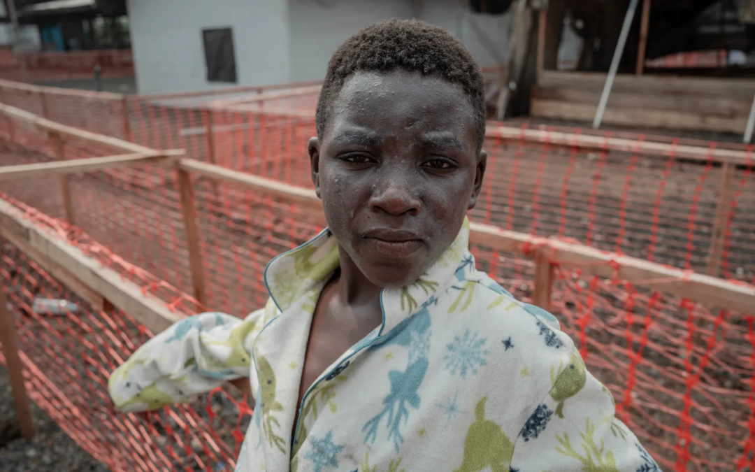 Experts Cautious as New Mpox Strain Emerges, Raising Concerns in the U.S.