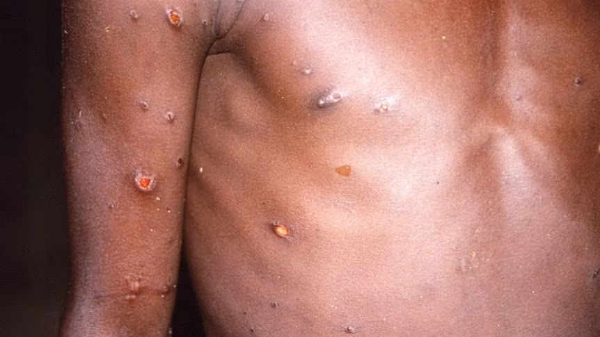 First Case of New Mpox Variant Clade 1b Confirmed in Germany